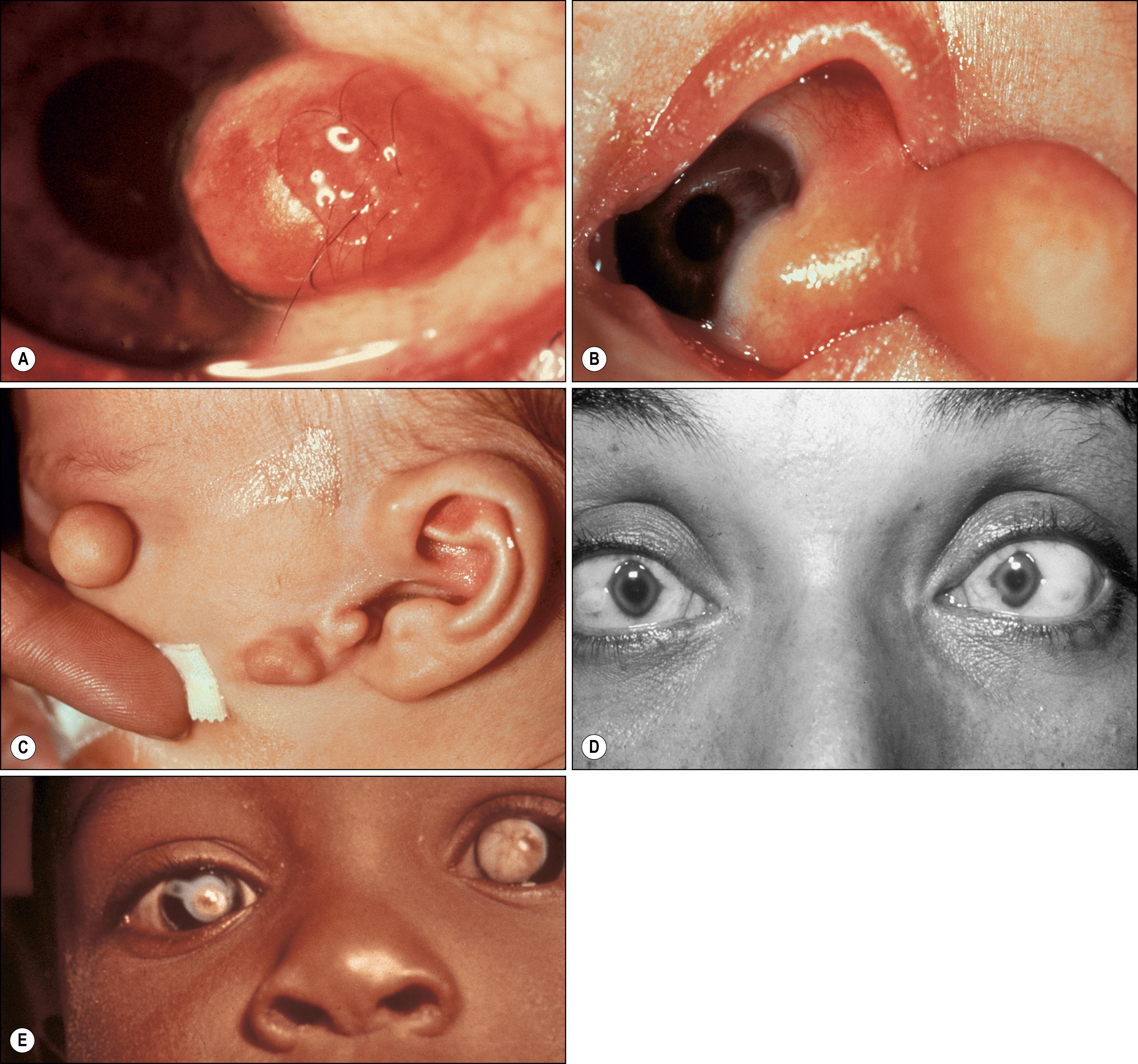 Fig. 54.1, Conjunctival dermoid.