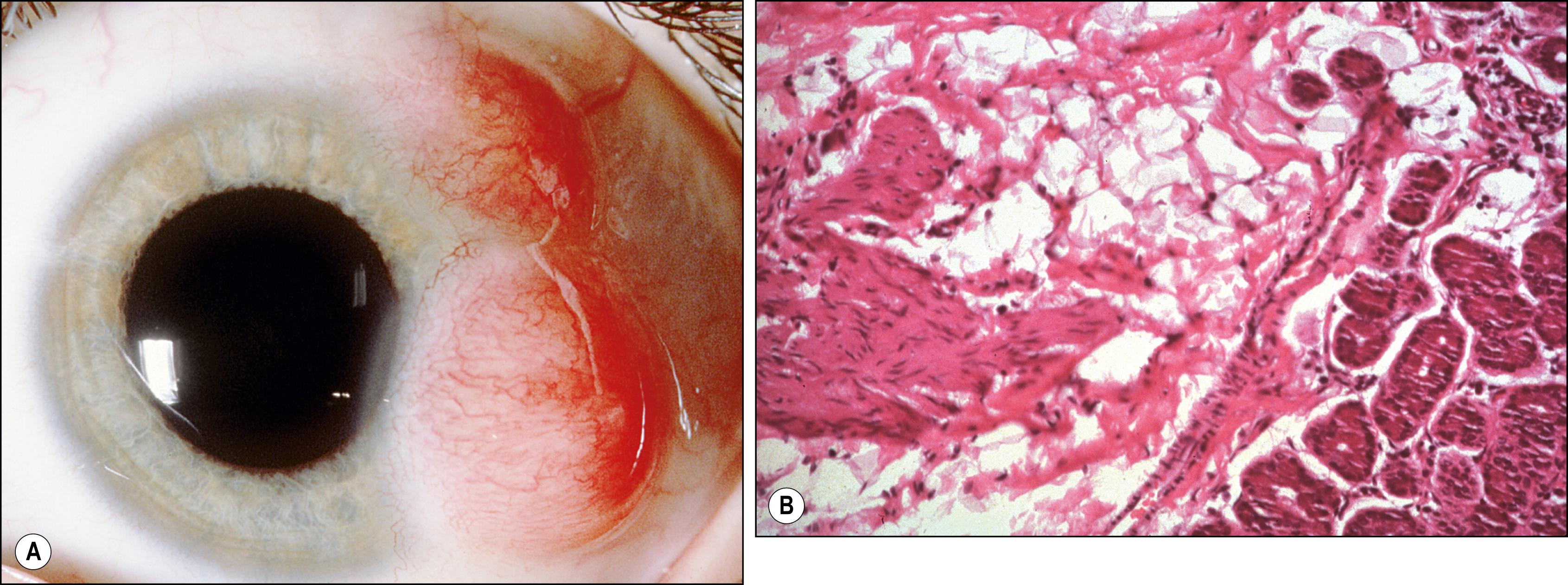 Fig. 54.3, Ectopic lacrimal gland.