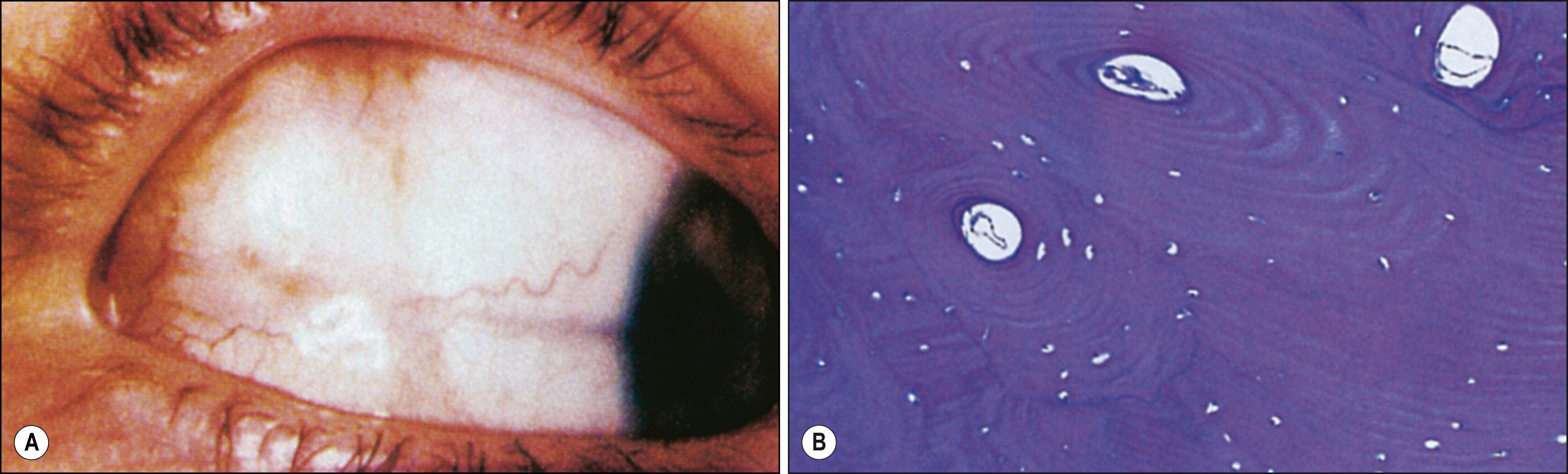 Fig. 54.4, Epibulbar osseous choristoma.