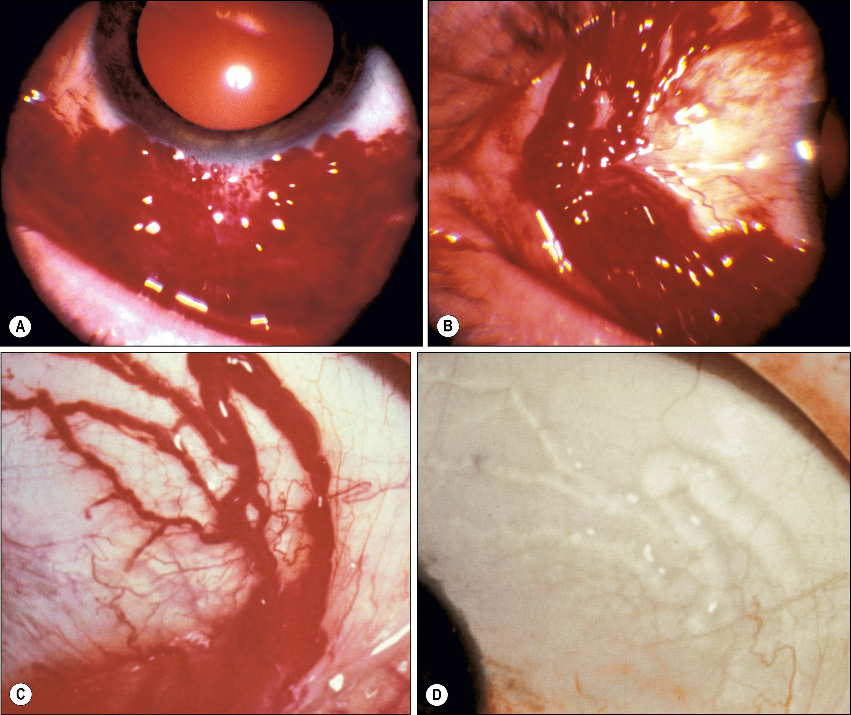 Fig. 54.5, Leber hemorrhagic lymphangiectasia.