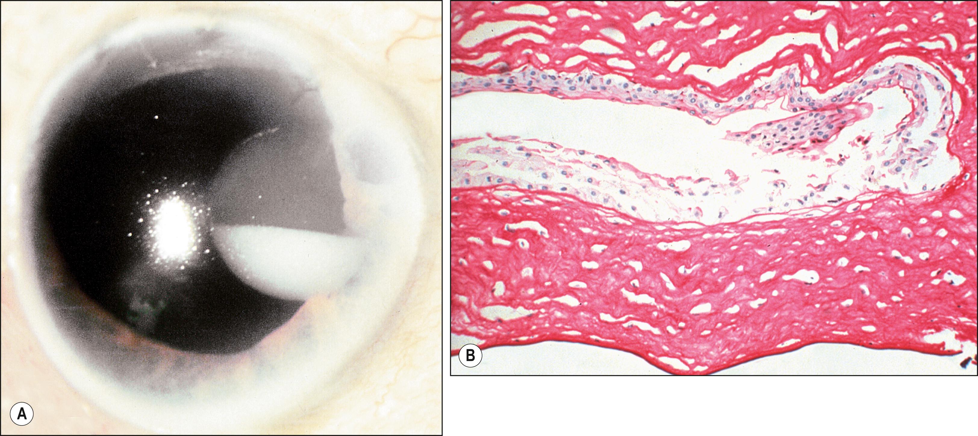 Fig. 54.6, Intrastromal corneal cyst.