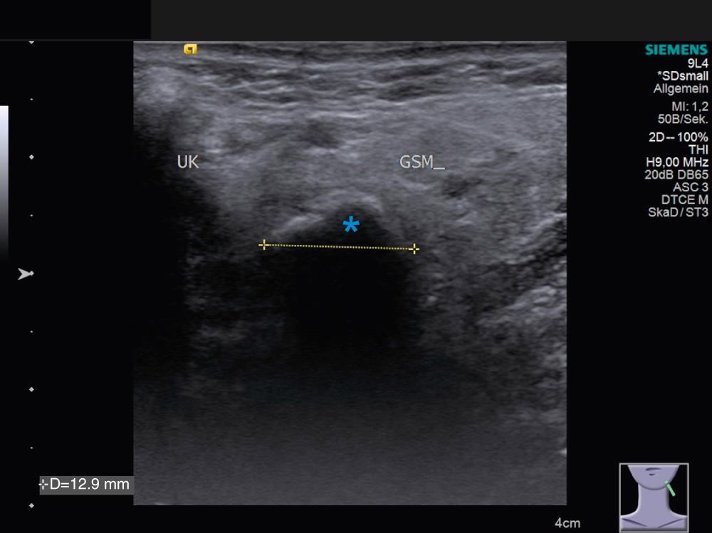 Fig. 18.2, Ultrasound of the submandibular gland (GSM) in coronal plane. The stone (*) thus can be measured in two dimensions. UK = mandible.