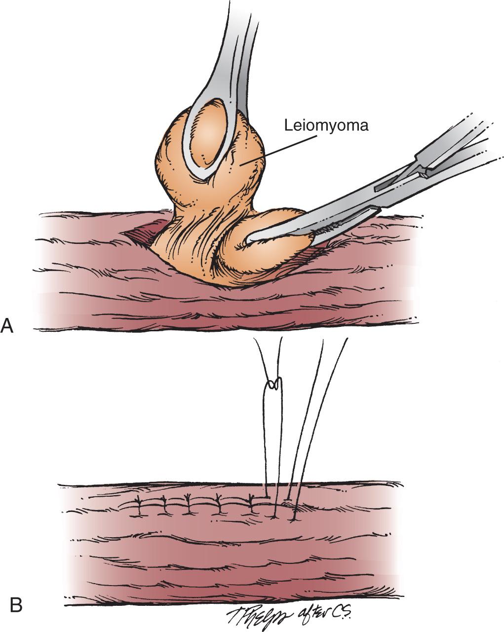 FIGURE 46.1, (A) The esophageal muscular fibers are split and the leiomyoma is bluntly extracted from the esophageal wall. (B) Once removed, the muscular defect is reapproximated.