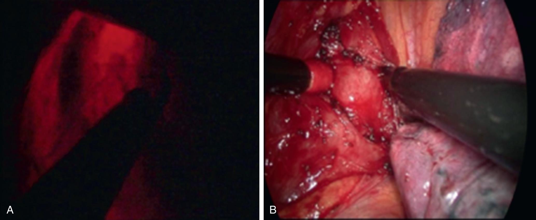 FIGURE 46.2, Tumor localization was performed under esophagoscopy, and myotomy was performed at the tumor level. (A) Tumor localization by transillumination. (B) Myotomy at the tumor level.