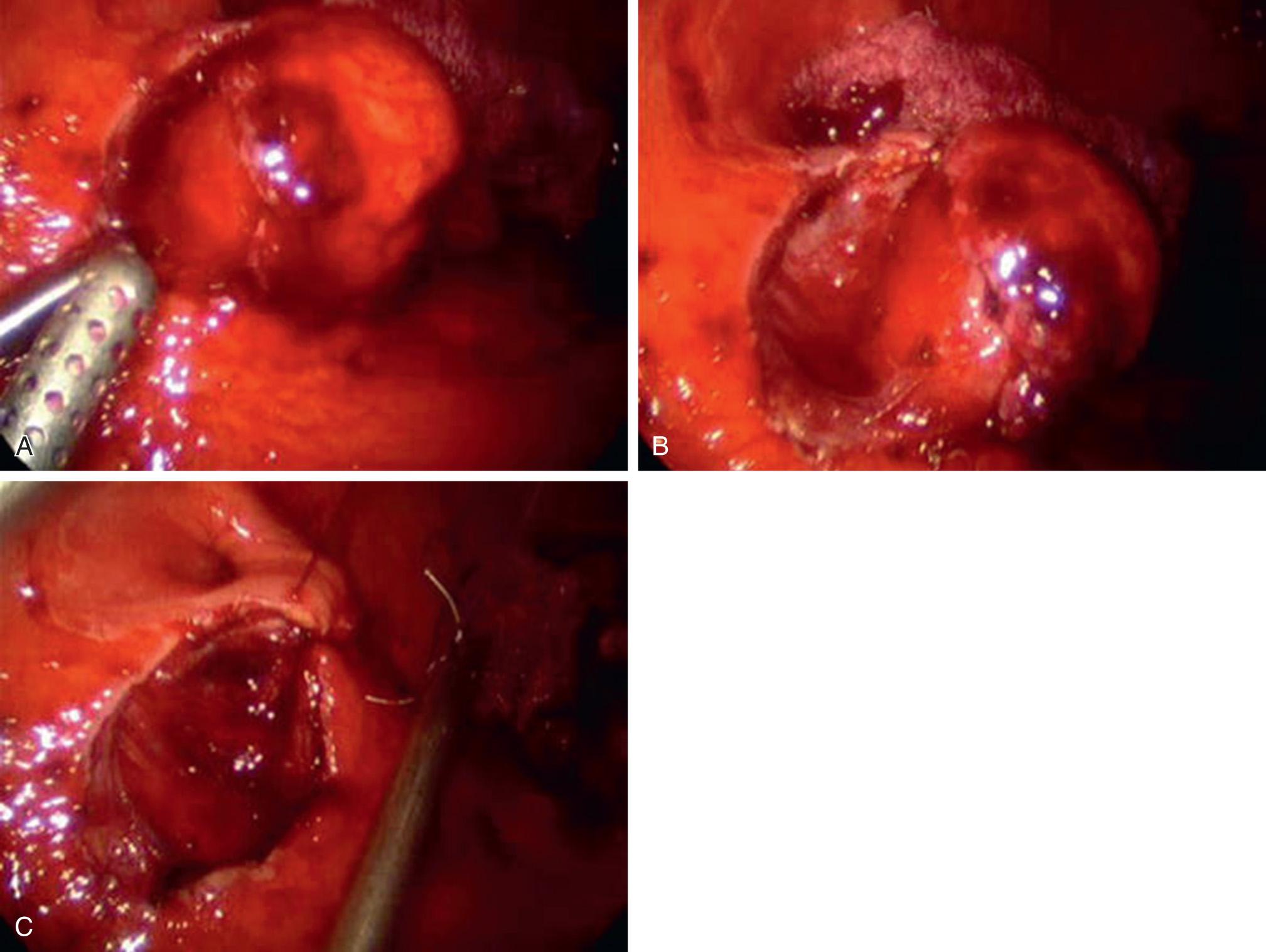 FIGURE 46.3, (A) Intraluminal submucosal lesion. (B) Partially enucleated lesion. (C) Intracorporeal closure of the mucosal and submucosal defect.