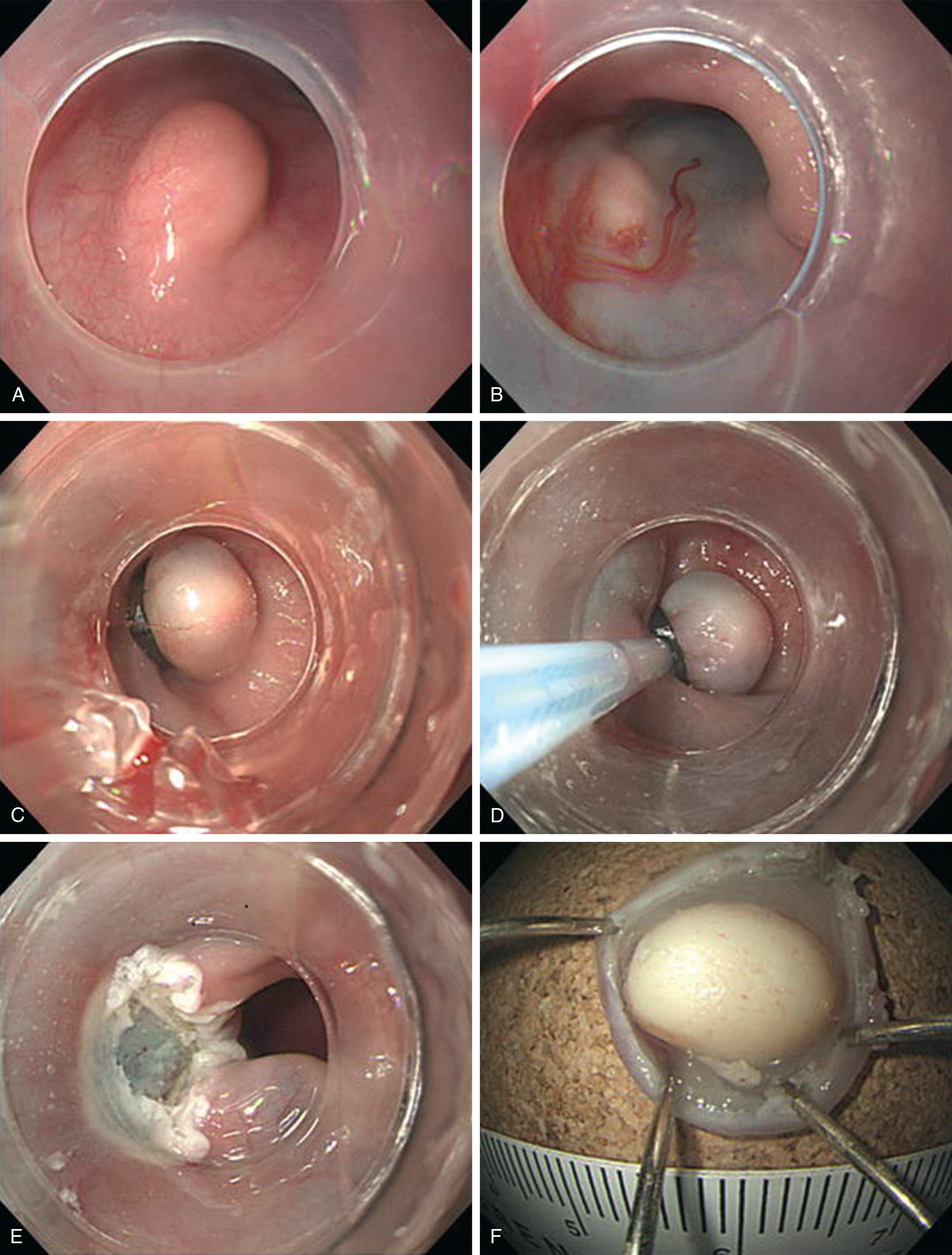 FIGURE 46.4, Endoscopic mucosal resection of a submucosal tumor (SMT) using a ligation device in the esophagus. (A) An SMT is observed in the lower esophagus. (B) Saline solution with a small amount of epinephrine and indigo carmine dye is injected beneath the lesion to elevate it. (C) The lesion is then aspirated into the ligation device, followed by deployment of the elastic band. (D) Snare resection is performed using a blended electrosurgical current. (E) The lesion is completely removed. (F) Inner surface of the resected specimen.