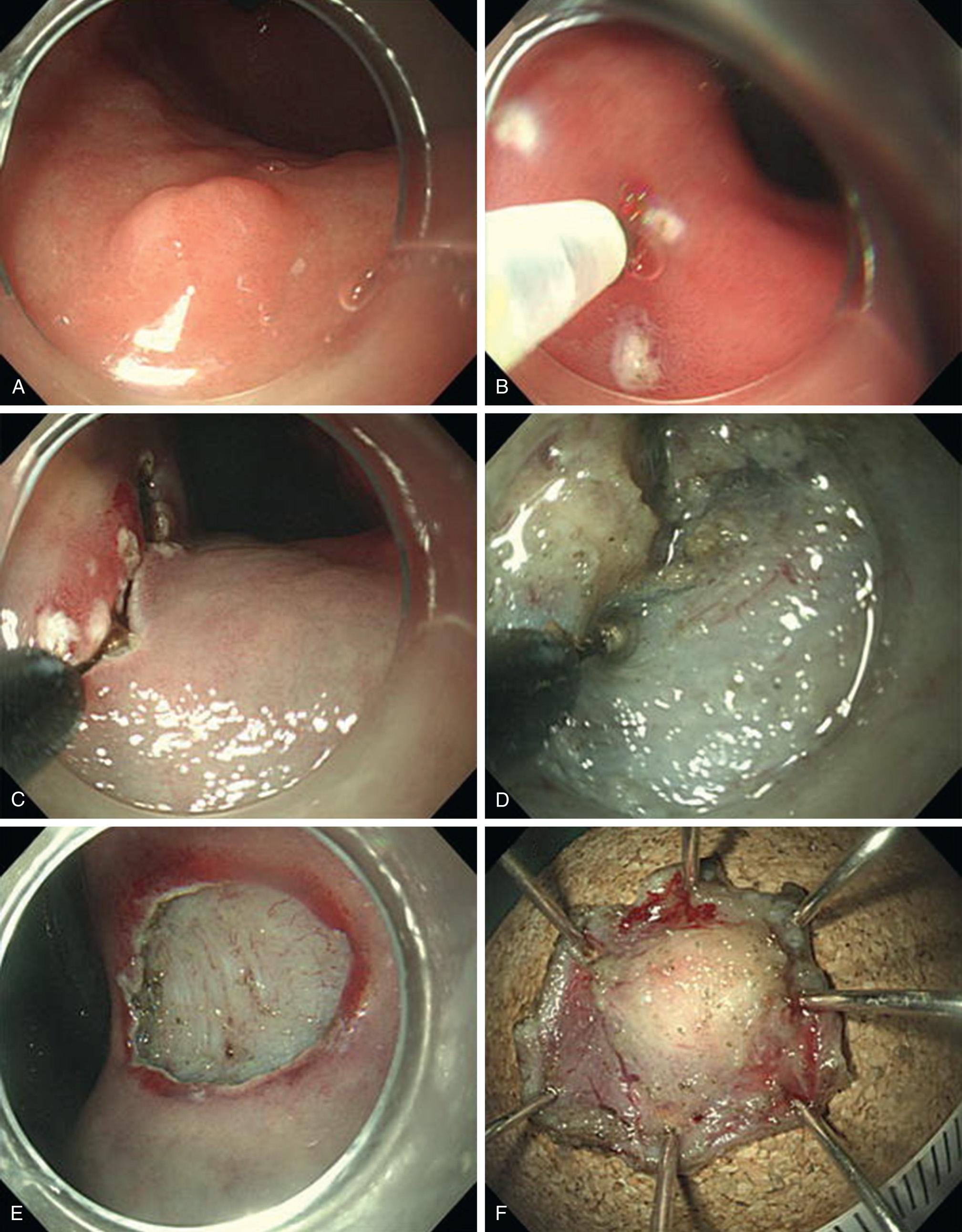 FIGURE 46.5, Endoscopic submucosal dissection of a submucosal tumor (SMT) in the stomach. (A) An SMT is observed in the upper body of the stomach. (B) Marking dots are made around the lesion and saline with epinephrine and indigo carmine is then injected into the submucosa beneath the lesion. (C) A complete circumferential incision is made using an insulated-tip (IT) knife. (D) Submucosal dissection is made using an IT knife. (E) The lesion is completely removed. (F) Inner surface of the resected specimen.
