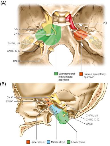 Figure 16.1, Cranial-caudal (A) and lateral views (B) of the exposure provided by the subtemporal–infratemporal (ST–ITA), and the subtemporal transapical (STA) approaches are shown. The ST–ITA approach provides a much greater exposure than the STA approach, but requires the mobilization of the entire petrous internal carotid artery (ICA), with the sacrifice of the eustachian tube. Both approaches gain access to the middle clivus region. CN , cranial nerve.