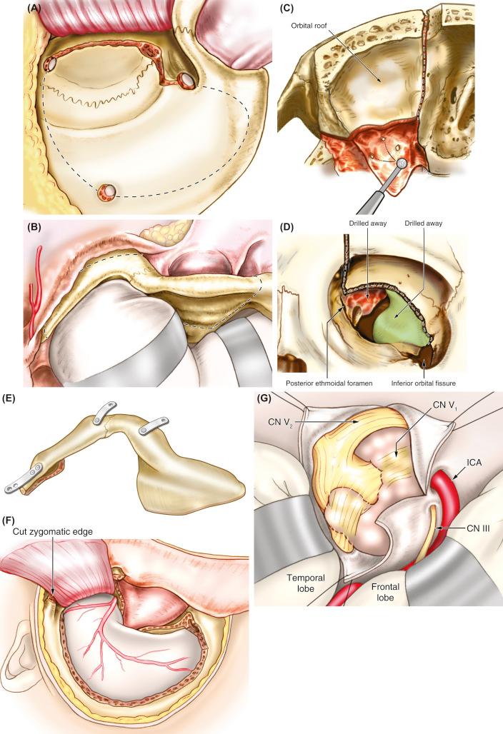 Figure 16.2, Frontotemporal orbitozygomatic approach: A frontotemporal craniotomy has been done. (A) The osteotomy cuts for a standard orbitozygomatic osteotomy (OZO) without the condylar osteotomy (B). The osteotomy cuts in the orbital roof are shown (C). This shows the orbital osteotomy from an anterior perspective; note the lateral and inferior extensions to the inferior orbital fissure (D). A completed OZO including a condylar osteotomy is shown (E). The final appearance after the craniotomy and the OZO for the frontotemporal transcavernous approach is shown (F). This shows intradural exposure of tumor in the cavernous sinus. The lateral dural wall over the tumor has been incised. One can see the semilunar ganglion, V1 and V2 (G).