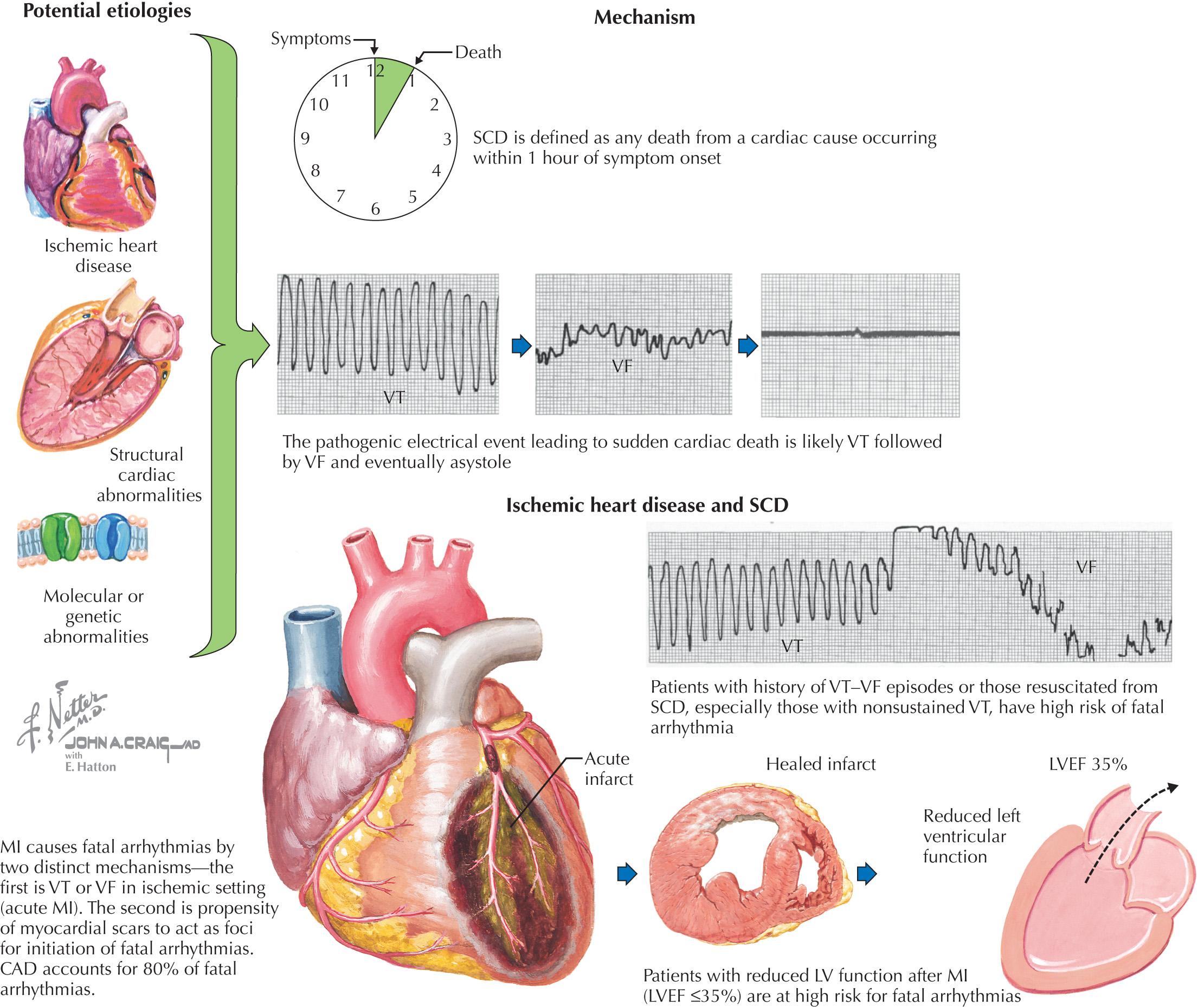 FIG 42.2, Mechanisms of Sudden Cardiac Death (SCD): Ischemic Heart Disease.
