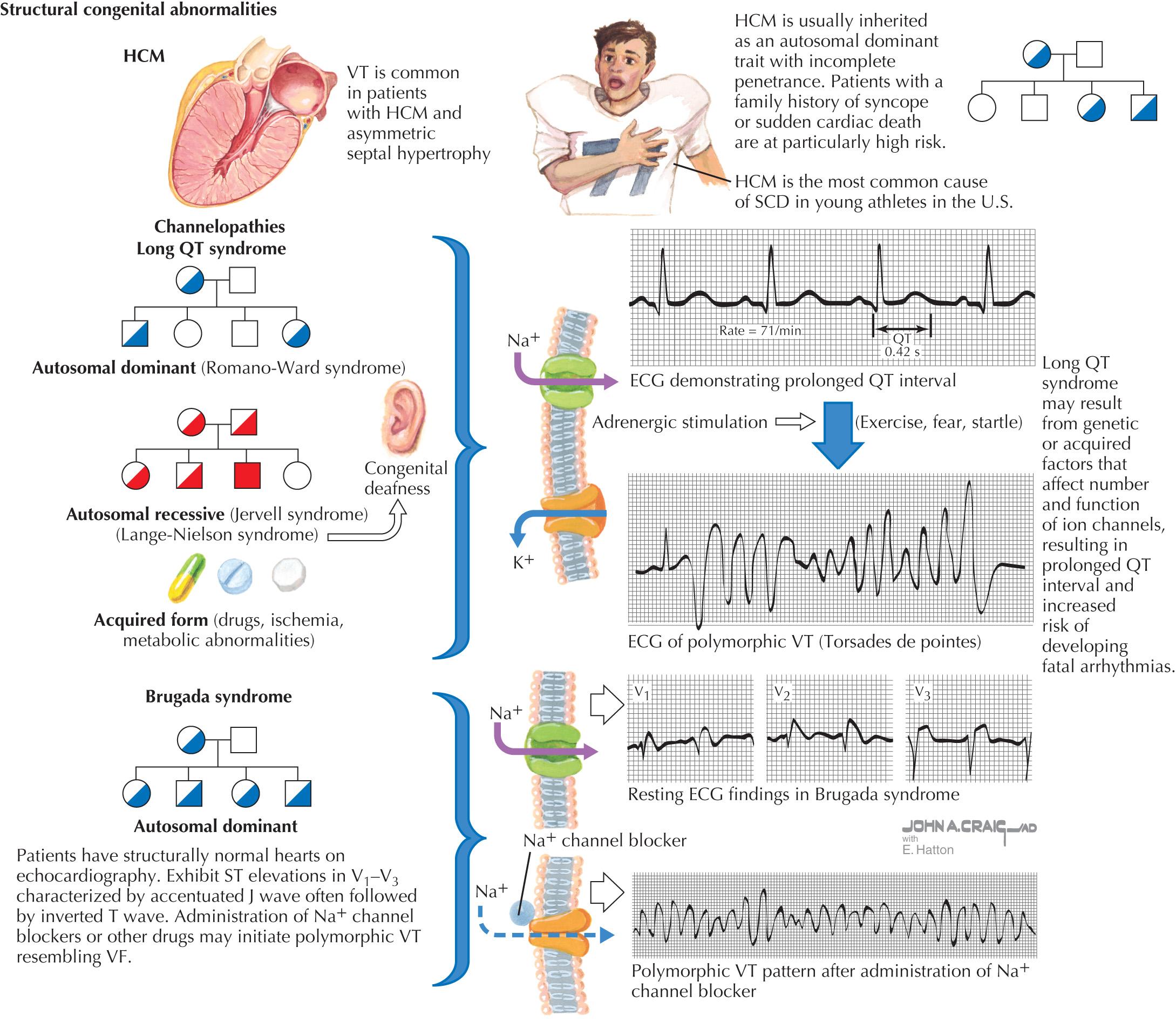 FIG 42.3, Mechanisms of Sudden Cardiac Death (SCD): Inherited Cardiomyopathies.