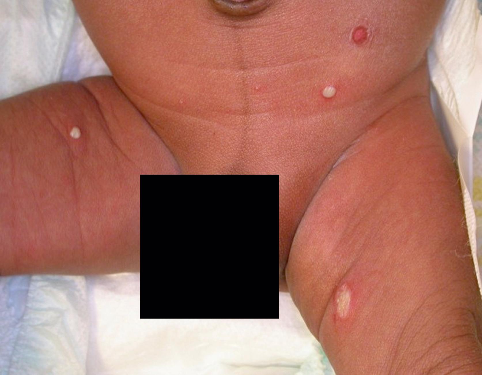 FIGURE 67.1, Scattered pustules on the abdomen and thighs of an infant with bullous impetigo caused by Staphylococcus aureus . One lesion has ruptured, leaving an erosion with a collarette of scale.