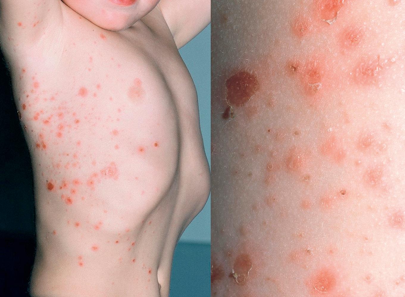 FIGURE 67.2, On the left, there are multiple superficial vesicles and shallow erosions on the right axilla and thorax in a child with bullous impetigo. A closer view of the child’s skin on the right shows superficial vesicles and shallow erosions, a few of which have surrounding collarette of scale.