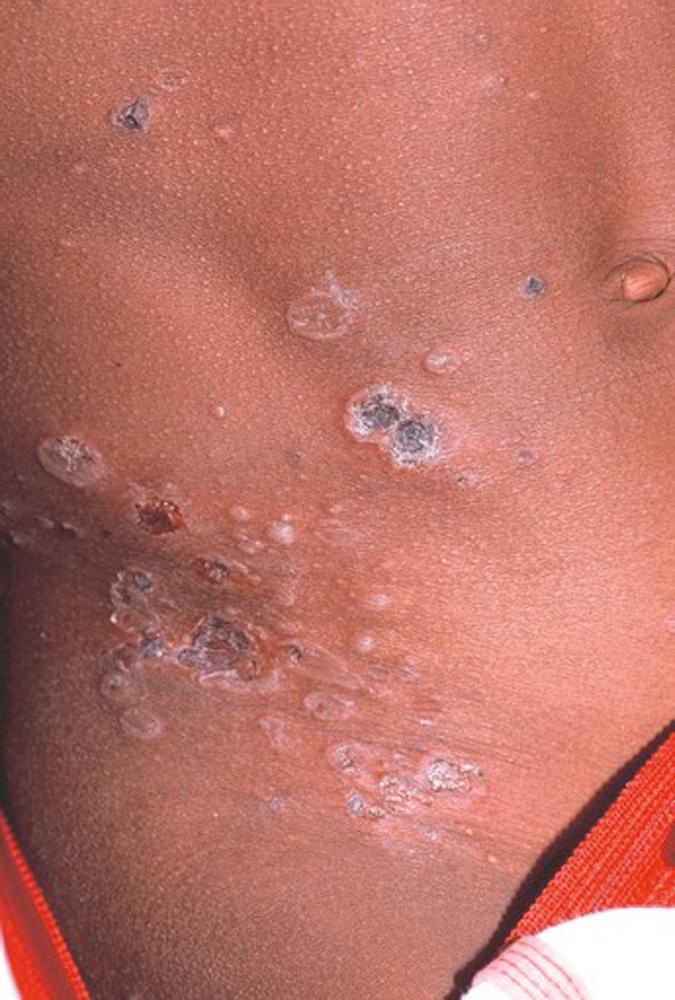 FIGURE 67.3, Bullous impetigo in a child shows multiple flaccid vesicles/bullae and shallow erosions, some with overlying crusting and a surrounding collarette of skin.