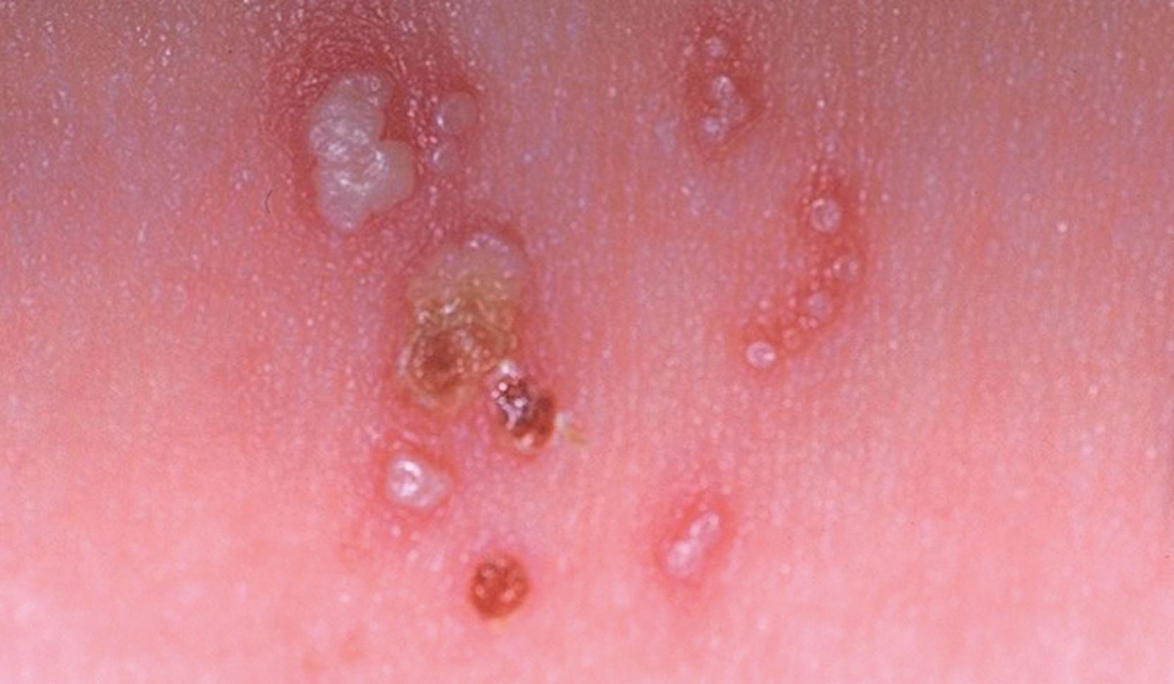 FIGURE 67.4, Clustered vesicles on an erythematous base, several of which are coalescing on the skin of a neonate with herpes simplex virus infection. Three of these vesicles have ruptured, leaving shallow erosions and overlying hemorrhagic crusting.