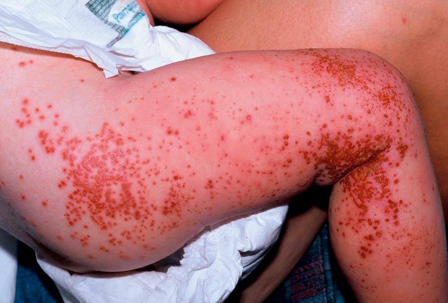 FIGURE 67.5, Numerous clustered vesicles and coalescing, punched out erosions on an erythematous base on the lower extremity of a child with eczema herpeticum.