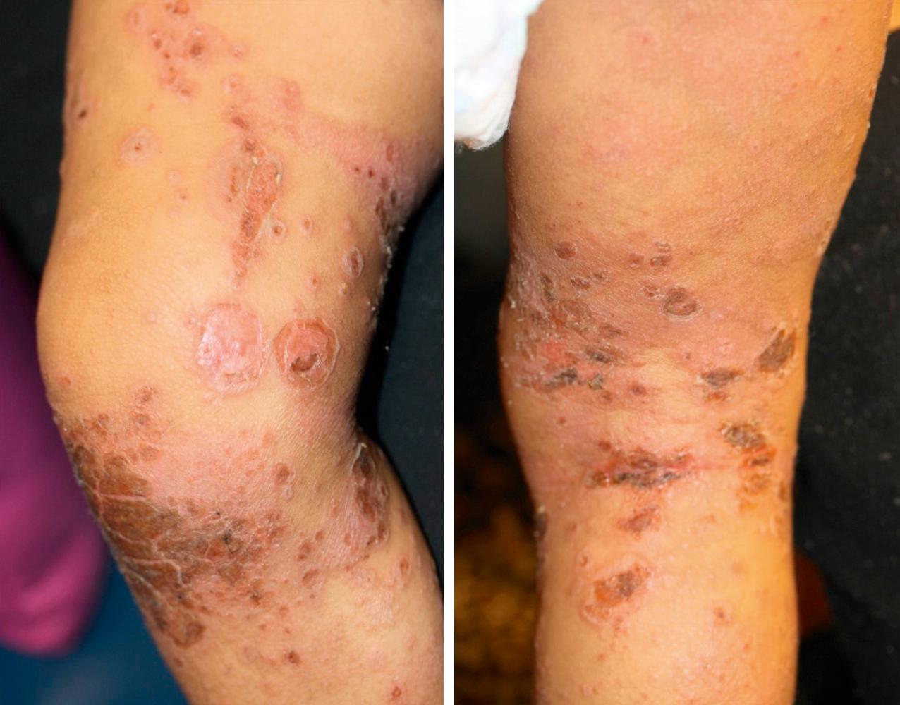 FIGURE 67.6, Scattered shallow erosions from ruptured vesicles and bullae, some with overlying crusting on the lower extremity of a child with eczema coxsackium (note the shallow nature of the erosions, unlike those seen in eczema herpeticum).