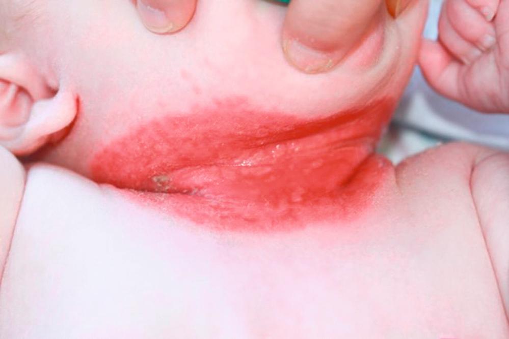 FIGURE 67.10, Well-demarcated bright red erosive patch on the neck of an infant with streptococcal intertrigo.