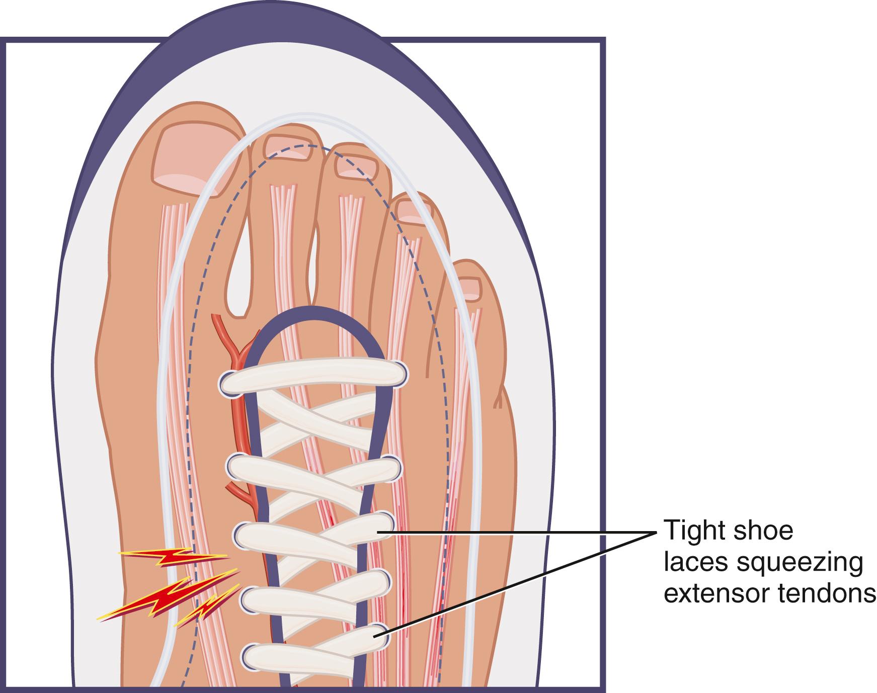 FIG. 191.1, Shoes, boots, or ice skates that are laced too tightly, as well as wrinkles in the tongue of a tightly laced shoe, have been implicated as the inciting factor of acute superficial extensor tendinitis.