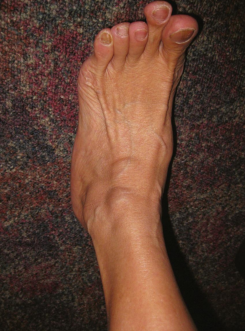 FIG. 191.2, Dumbbell ganglion of the extensor digitorum longus tendon at the level of the ankle joint.