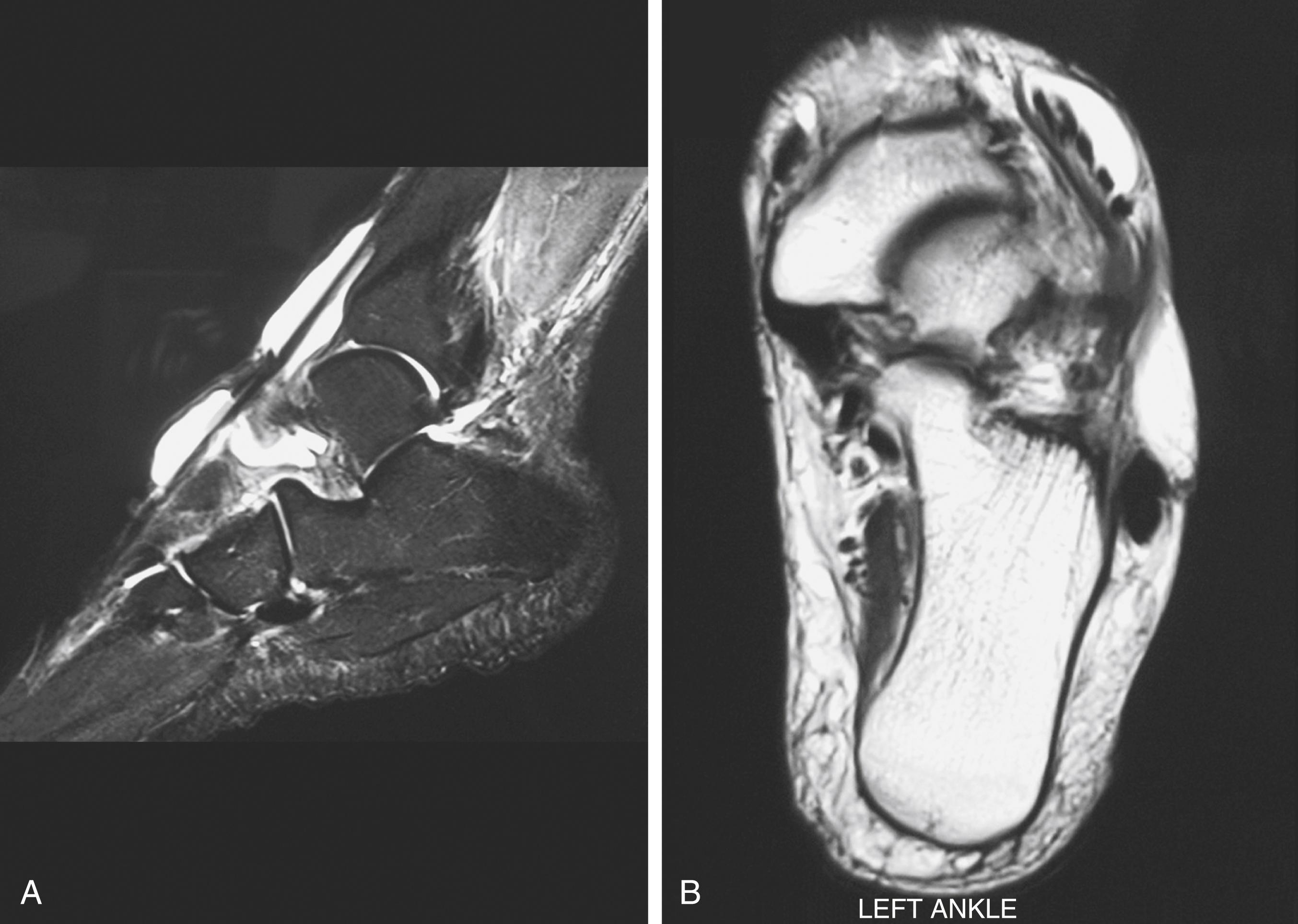 FIG. 191.3, Sagittal (A) and transverse (B) views of the magnetic resonance image of the ankle suggest tenosynovitis of the extensor digitorum longus tendon.