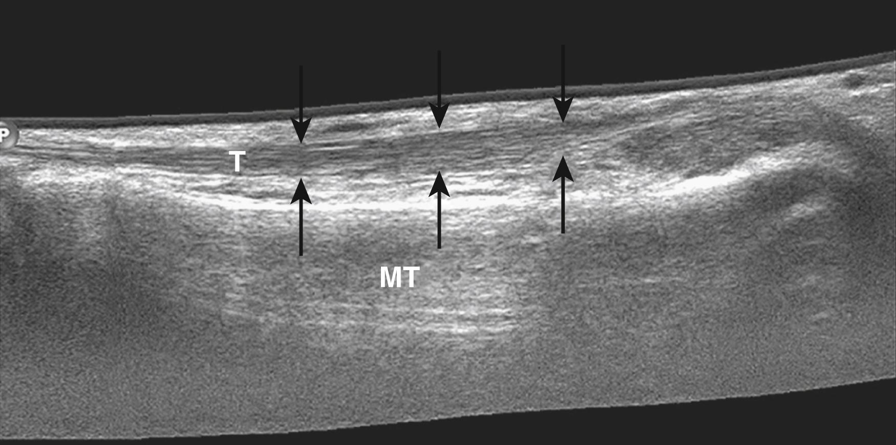 FIG. 191.4, Longitudinal extended field-of-view image of the extensor hallucis longus tendon (T) on the first metatarsal bone (MT) shows a diffusely thickened, hypoechoic tendon (arrows).