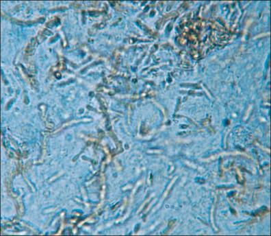 Figure 17-1, Dematiaceous hyphae and yeast cells of H. werneckii in stratum corneum. Potassium hydroxide preparation.