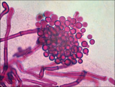 Figure 17-4, M. furfur in stratum corneum, periodic acid–Schiff stain.