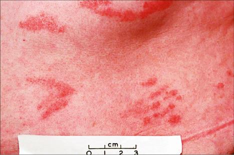 Fig. 8.1, Chronic superficial dermatitis: this patient shows digitate erythematous lesions in a characteristic distribution.