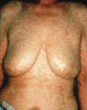 Fig. 8.12, Erythema gyratum repens: the presence of annular erythematous parallel bands with scaling is characteristic.