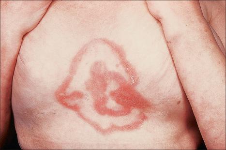 Fig. 8.13, Erythema gyratum repens: the eruption may sometimes have a bizarre appearance.