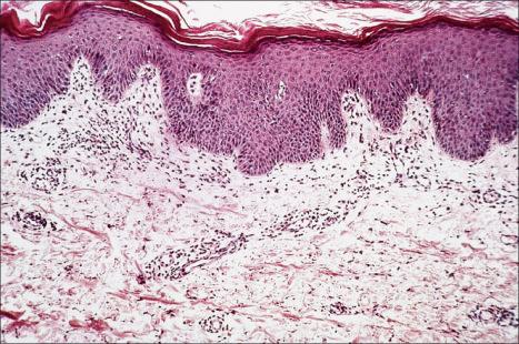 Fig. 8.14, Erythema gyratum repens: there is hyperkeratosis, acanthosis and a mild perivascular chronic inflammatory cell infiltrate.