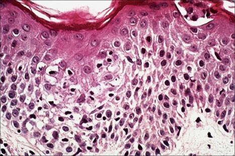 Fig. 8.15, Erythema gyratum repens: spongiosis is present.