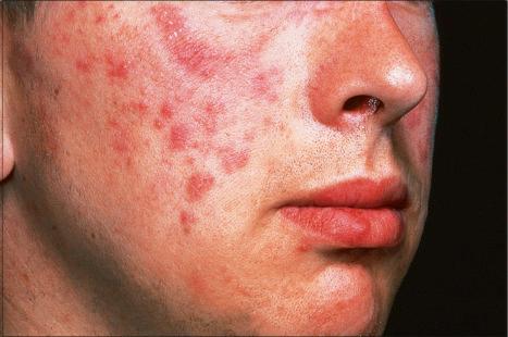 Fig. 8.16, Jessner lymphocytic infiltrate: there are multiple erythematous plaques on this young man's cheek.