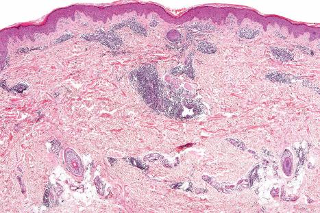 Fig. 8.18, Lymphocytic infiltrate of Jessner: a heavy chronic inflammatory cell infiltrate cuffs the vessels in the superficial and mid dermis.