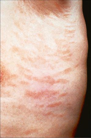 Fig. 8.2, Chronic superficial dermatitis: these uniform, linear lesions had been present for many years.