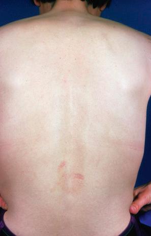 Fig. 8.22, Reticular erythematous mucinosis: location in the lower back is unusual.