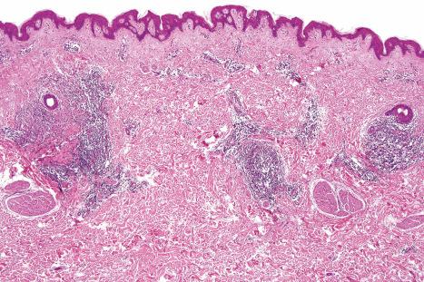 Fig. 8.24, Reticular erythematous mucinosis: there is a perifollicular and perivascular infiltrate in the upper and mid dermis.