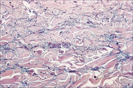 Fig. 8.26, Reticular erythematous mucinosis: increased dermal mucin (hyaluronic acid) separates the collagen fibers (Alcian blue stain).