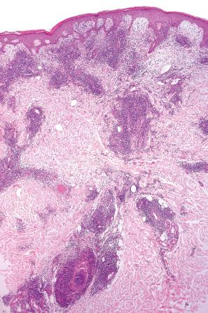 Fig. 8.29, Polymorphous light eruption: there is papillary dermal edema and a dense superficial and deep perivascular inflammatory cell infiltrate.