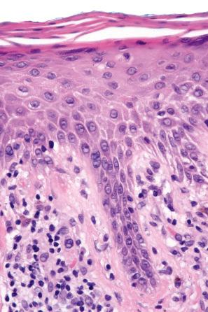 Fig. 8.5, Chronic superficial dermatitis: there is very slight intercellular edema. The infiltrate consists of lymphocytes and histiocytes.