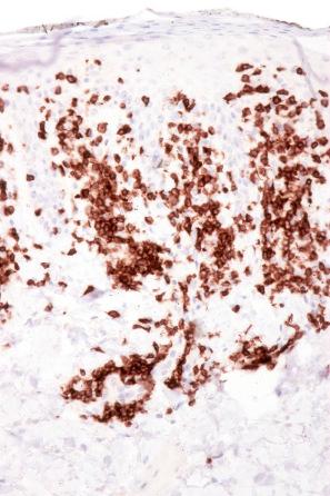 Fig. 8.6, Chronic superficial dermatitis: the infiltrate is composed predominantly of CD4+ T-helper cells.