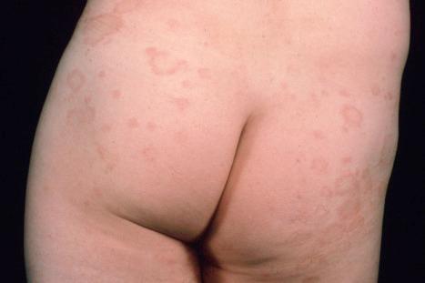 Fig. 8.8, Erythema annulare centrifugum: bilateral annular lesions are present on the buttocks.