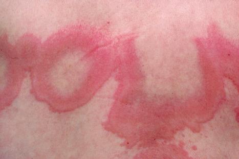 Fig. 8.9, Erythema annulare centrifugum: close-up view.