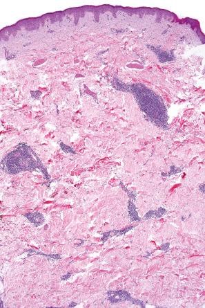 Fig. 8.10, Erythema annulare centrifugum: the superficial and deep vasculature is surrounded by a dense infiltrate.