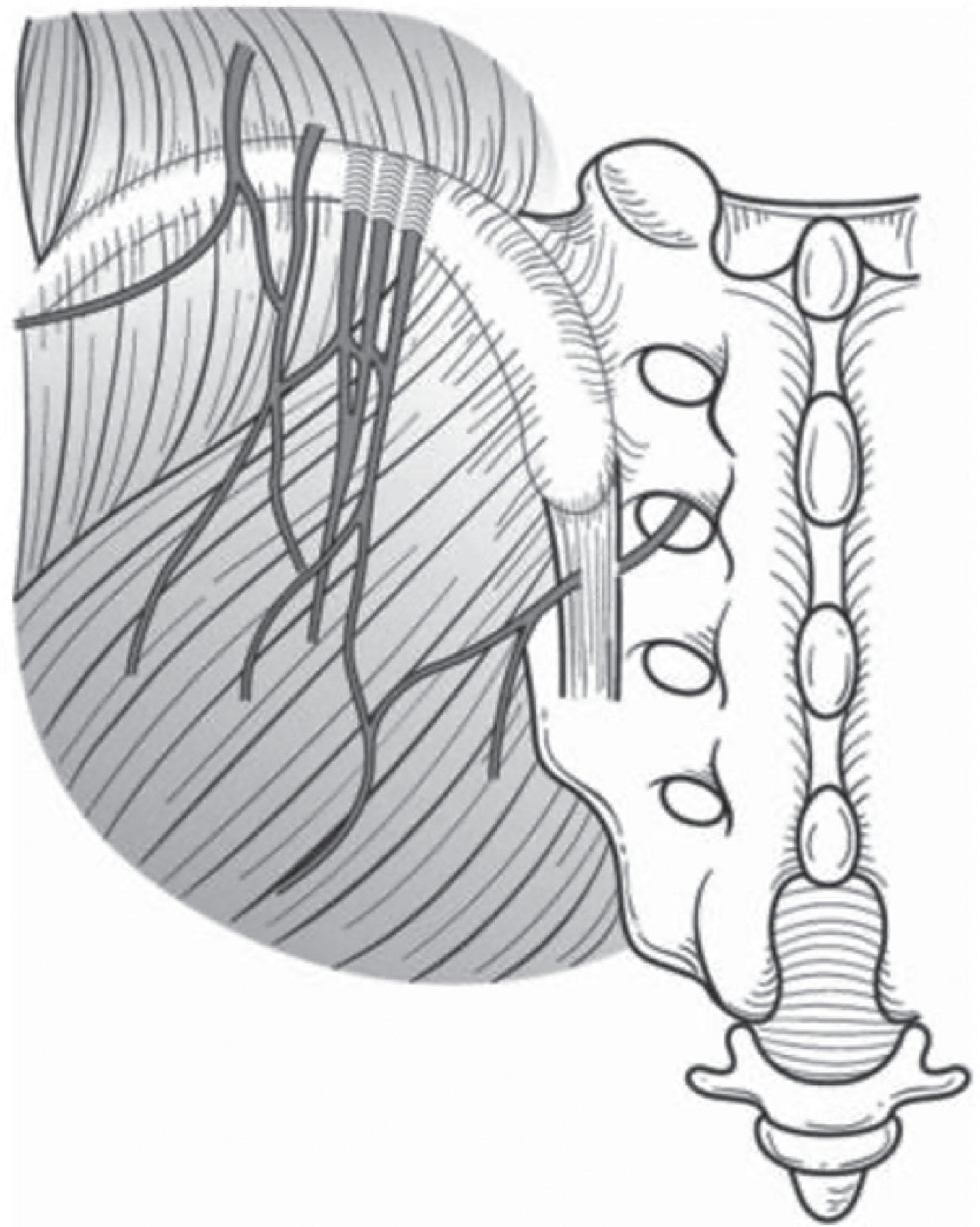 Figure 19.1, Anatomy of the superior cluneal nerves.