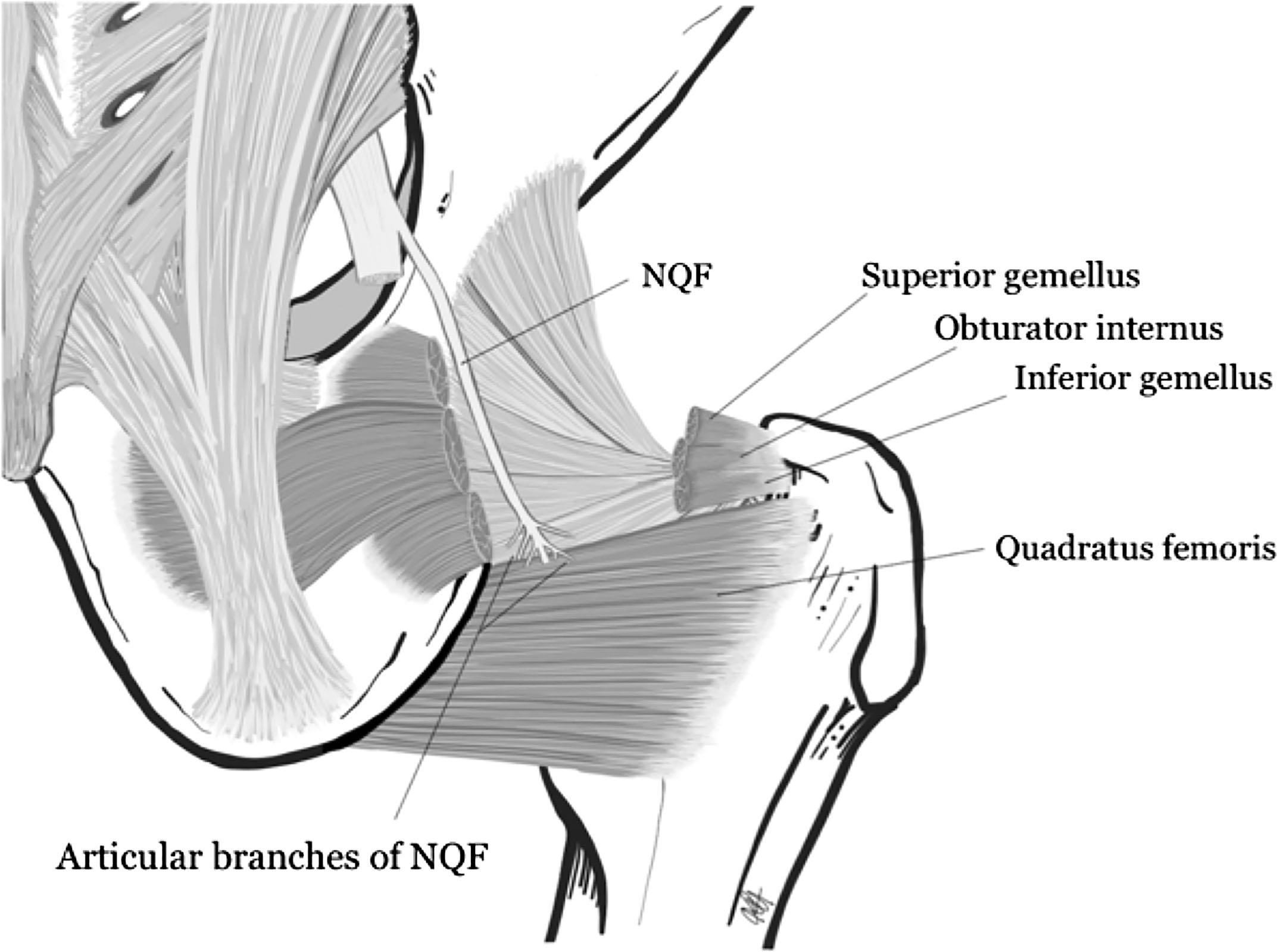 Figure 31.2, The nerve to quadratus femoris ( NQF ) is seen deep to the superior gemellus, obturator internus, and inferior gemellus muscles.