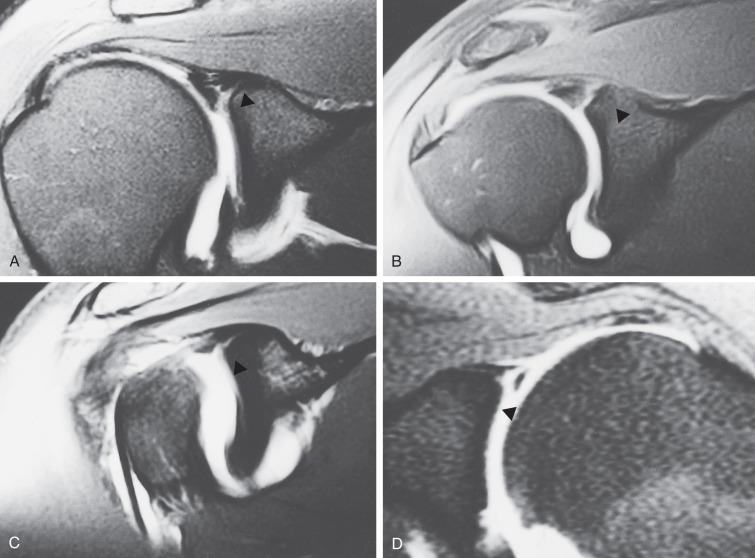 Fig. 44.4, Gadolinium-enhanced magnetic resonance images of superior labrum anterior to posterior (SLAP) lesions. Note the leakage of the dye under the biceps tendon insertion in four separate cases (arrowheads) . (A) Contrast dye extending lateral in the superior labrum, classically diagnostic of superior labral tear. (B) Complete extension of dye through the labrum superiorly. (C) Complex pattern with dye extending medial and intermediate signal extending lateral through the tissue of the labrum. (D) Contrast extending laterally with separation of labral tissue and irregular border of remaining labrum. These images can be diagnostic of a type II SLAP lesion.