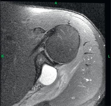 Fig. 44.5, A spinoglenoid notch cyst.