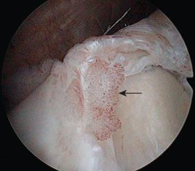 Fig. 44.6, A superior labrum with a type II superior labrum anterior to posterior lesion. Note the area of synovitis posterosuperiorly, indicating evidence of trauma (arrow) . Granulation tissue is an important finding to indicate a pathologic labral condition and not a normal variant.